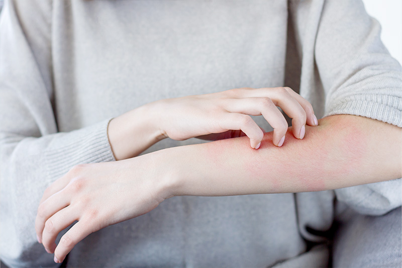 アレルギー性皮膚疾患に対応